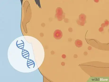 Image titled Tell if Acne Is Hormonal or Bacterial Step 6