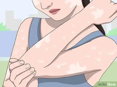 Image titled Prevent Vitiligo from Spreading Step 10