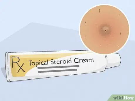 Image titled Remove an Ingrown Hair Under the Skin Step 11