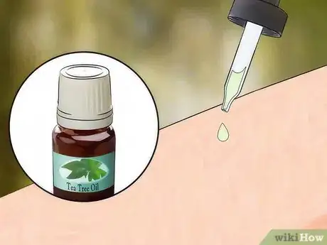 Image titled Get Rid of Bug Bites Step 11