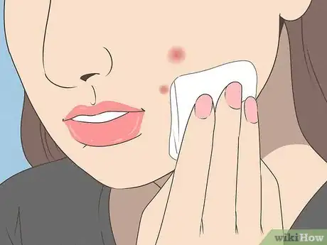 Image titled Reduce Pimple Redness and Size (Aspirin Method) Step 5