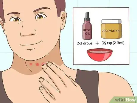 Image titled Treat a Rash on the Neck Step 11