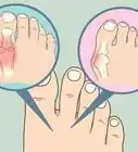 Soak an Ingrown Toenail