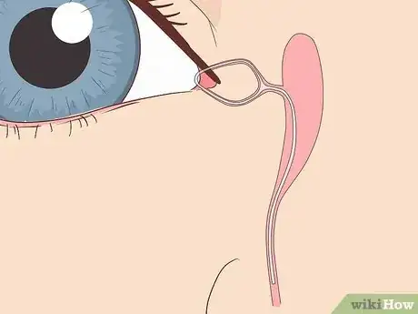 Image titled Clear a Blocked Tear Duct Step 11