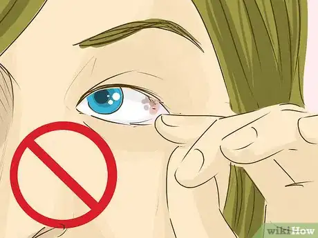 Image titled Remove Something from Your Eye Step 11