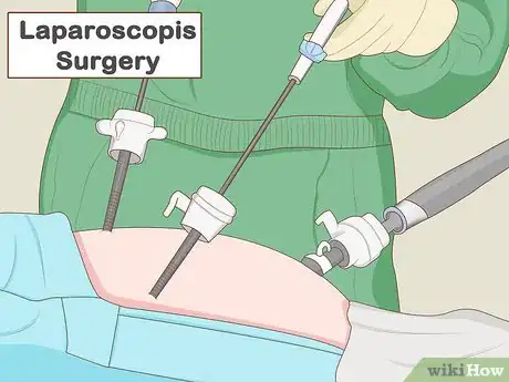 Image titled Reduce Appendix Pain Step 10