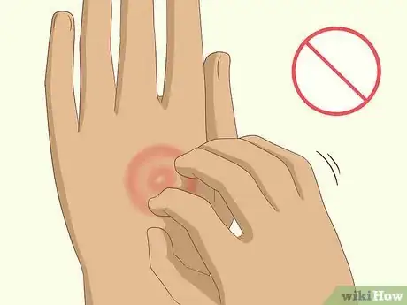 Image titled Get Rid of Ringworm Naturally Step 10