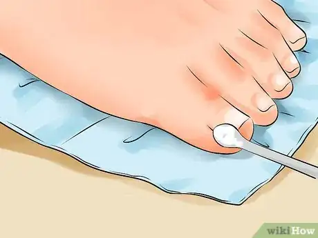 Image titled Remove an Ingrown Toenail Step 7