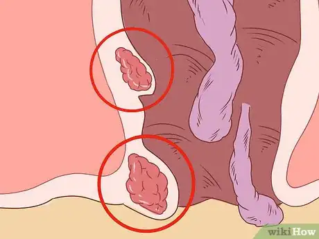 Image titled Care for Hemorrhoids Postpartum Step 27