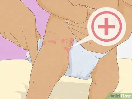 Image titled Treat Diaper Rash Step 5