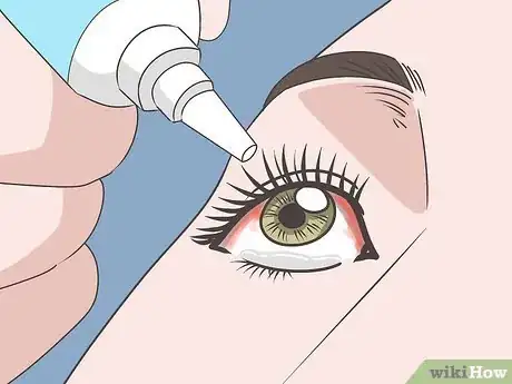 Image titled Heal a Popped Blood Vessel in Your Eye Step 1