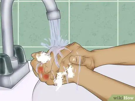 Image titled Treat Wax Burns Step 5