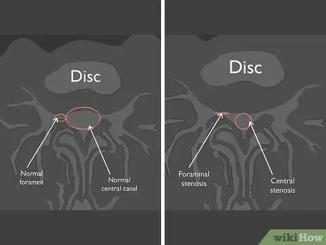 Image titled Read a Lumbar MRI Step 13