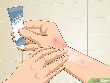 Image titled Get Rid of Poison Oak Rash Step 6