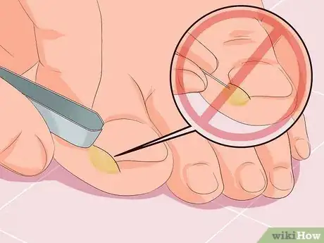 Image titled Remove Infection from an Ingrown Toenail Step 6