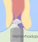 Get Rid of Hemorrhoids