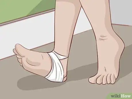 Image titled Treat a Foot Burn Step 15