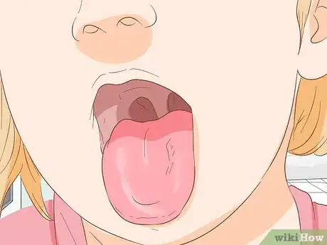 Image titled Stop Tongue Bleeding Step 11