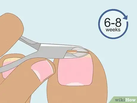 Image titled Trim Toenails with Fungus Step 7