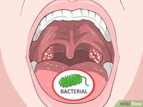 Image titled Tell a Viral from a Bacterial Infection Step 3