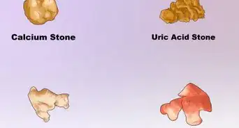 Dissolve Kidney Stones