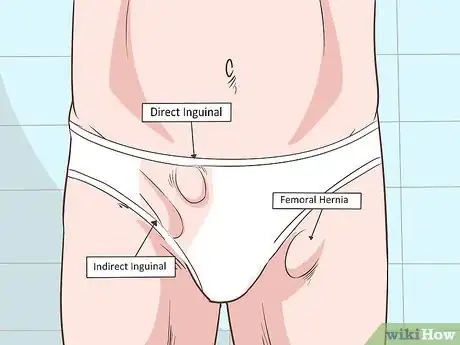 Image titled Recognize a Scrotal Hernia Step 4