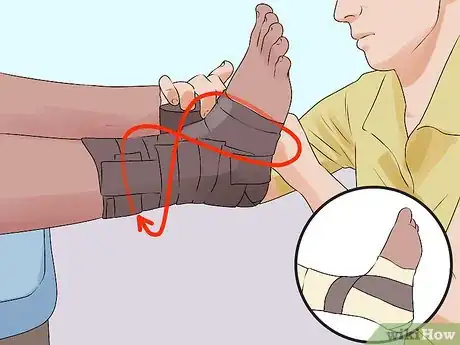 Image titled Tape an Ankle Like an Athletic Trainer Step 10