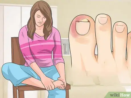 Image titled Tell if You Have an Ingrown Toenail Step 2