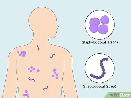 Image titled Know if You Have Toxic Shock Syndrome Step 10