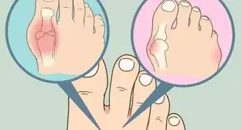 Soak an Ingrown Toenail