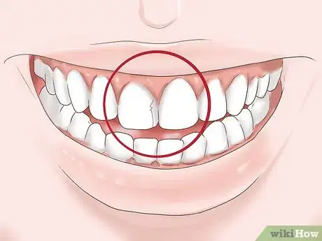 Image titled Know if Your Dental Fillings Need Replacing Step 8