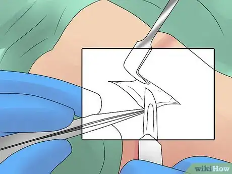 Image titled Treat Bursitis Step 13