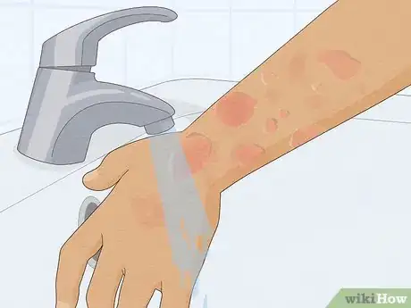 Image titled Recognize Hives (Rash) Step 9