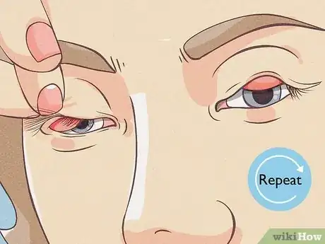 Image titled Flip Eyelids Inside Out Step 10