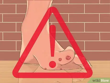 Image titled Get Rid of Plantar Warts (Verrucas) Step 15