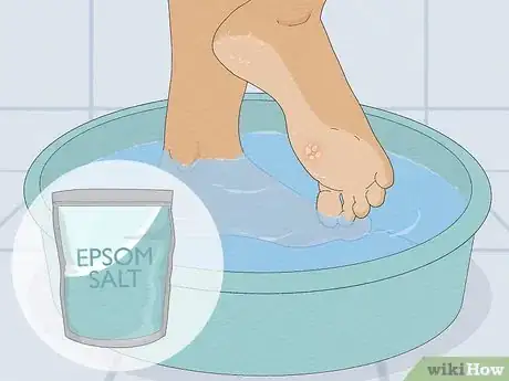 Image titled Get Rid of a Wart at the Bottom of Your Foot Step 1