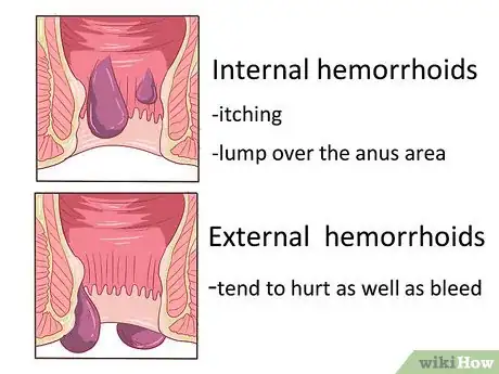 Image titled Get Rid of Hemorrhoids Naturally Step 1