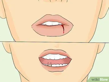 Image titled Heal a Swollen Lip Step 13