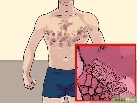 Image titled Recognize Skin Bacterial Infections Step 8