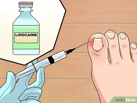 Image titled Cure an Infected Toe Step 5