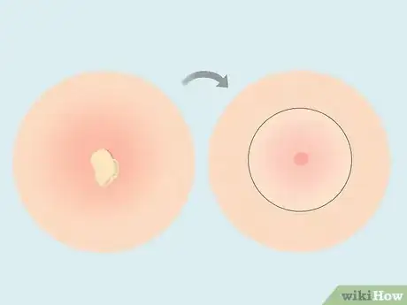 Image titled What to Do After Removing Pimple Patch Step 3