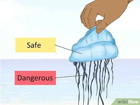 Image titled Treat a Portuguese Man O' War Sting (Bluebottle Sting) Step 16