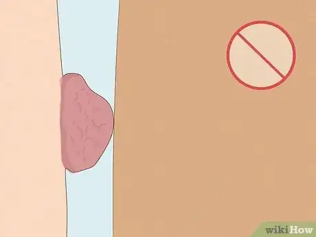 Image titled Remove an HPV Wart Using TCA Step 10