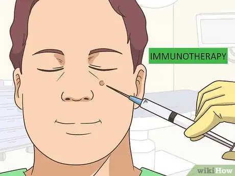 Image titled Remove Facial Warts Step 13