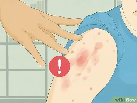 Image titled Recognize Scabies Rash Step 13