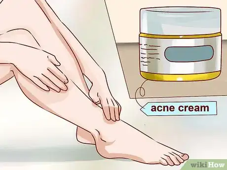 Image titled Get Rid of Leg Acne Step 8