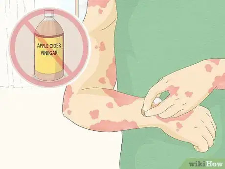 Image titled Use Apple Cider Vinegar for Psoriasis Step 4