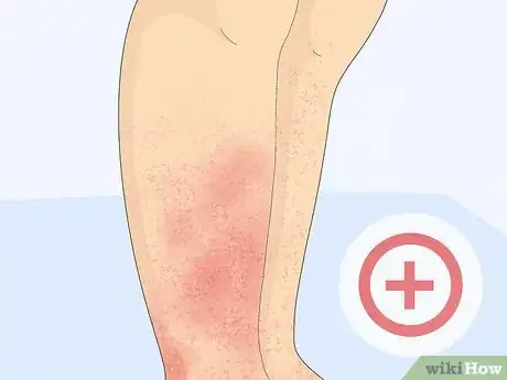 Image titled Treat a Face Rash After Waxing Step 15