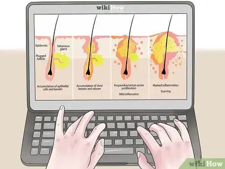 Image titled Treat an Infected Sebaceous Cyst Step 16