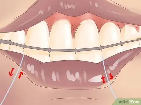 Image titled Stop Bleeding Gums, Gingivitis, Periodontitis Step 5